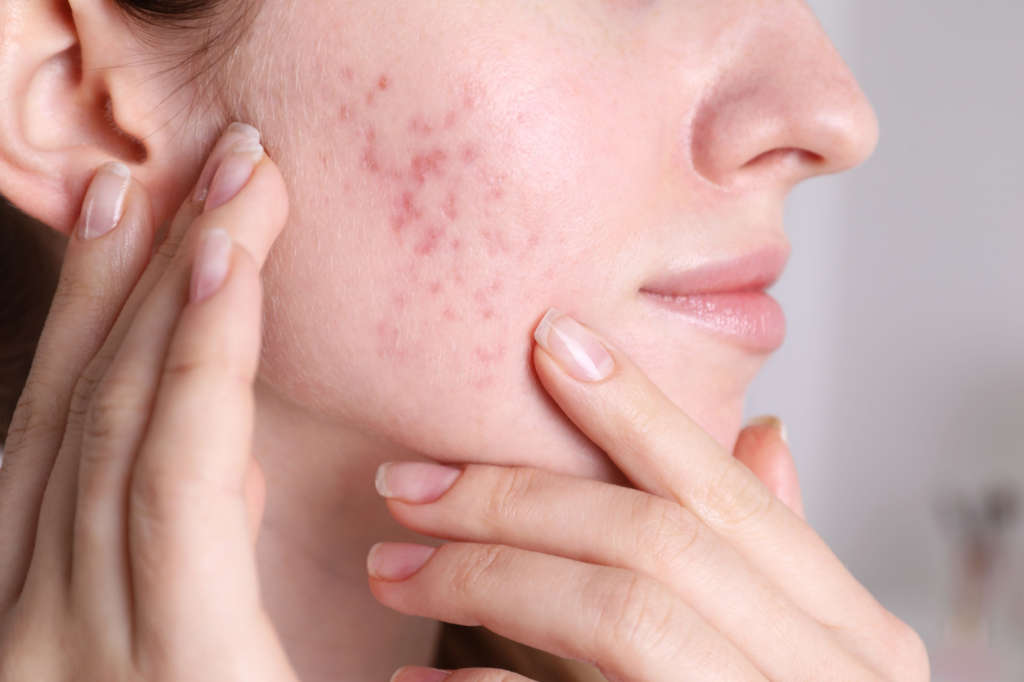 Close-up of a young woman’s cheek showing acne breakouts, redness, and post-acne marks as she examines her skin with her hands.